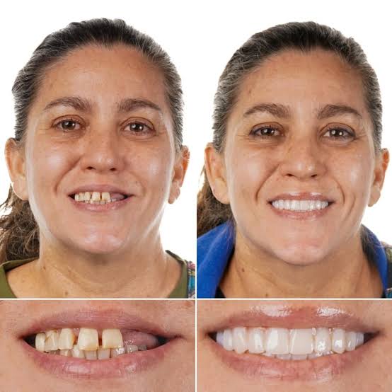 Dental Implants Before and after Oakville