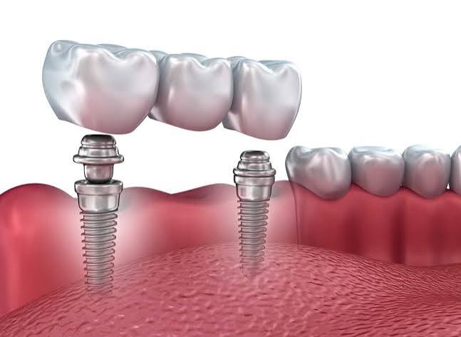 Dental Implants Oakville