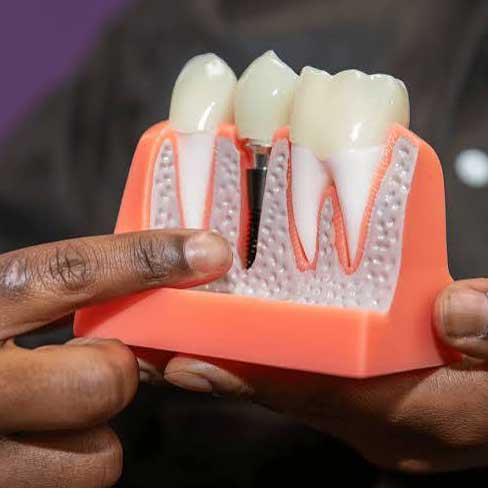 Dental-Implants-Oakville Bronte-Oak-Dental
