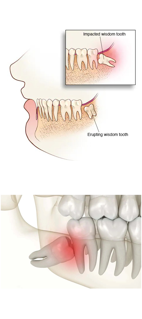 Impacted Wisdom Teeth